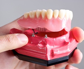 Model smile with removable dental implant retained denture
