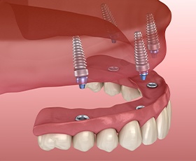 Animated hybrid all on 4 denture