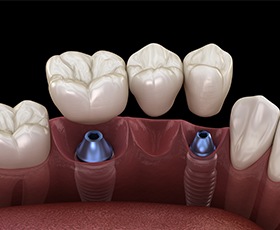 Animated dental implant supported dental bridge