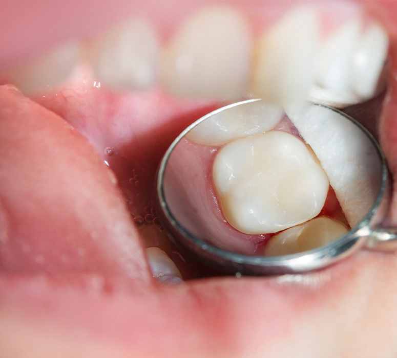 Closeup of health teeth after tooth colored filling placement