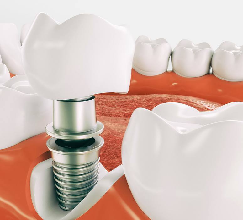 How dental implants work in Beachwood 