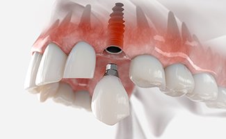 Up-close view of dental implant parts 