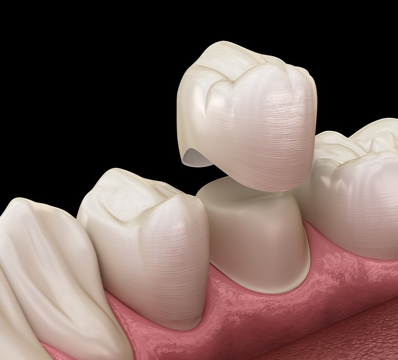 Animated dental crown placement