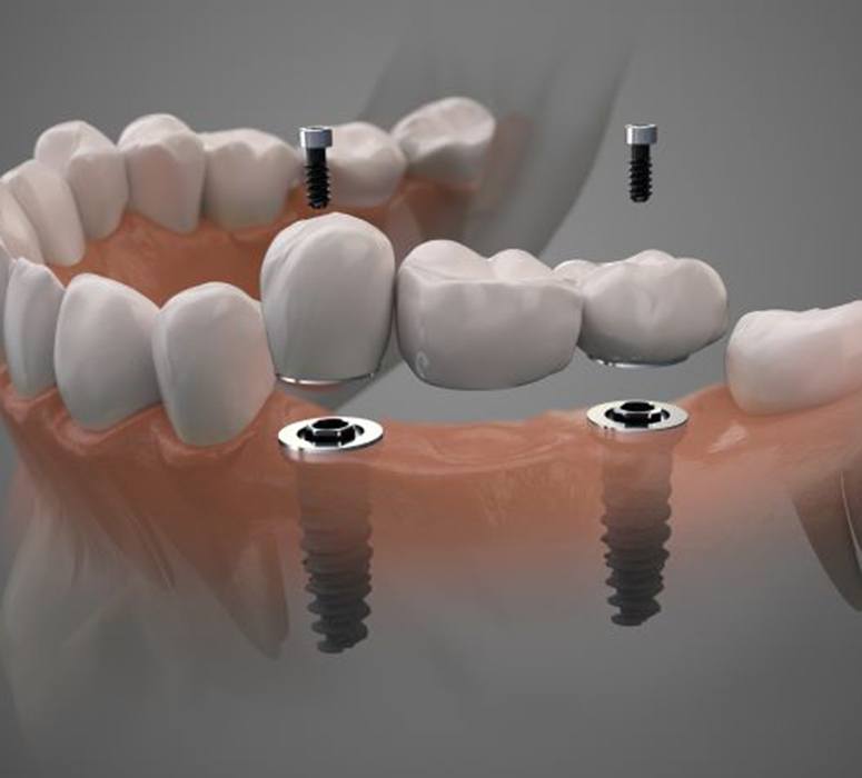 Types of Dental Bridges