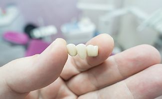 Implant Bridge