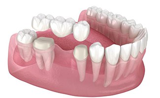 The Benefits of Getting a Dental Bridge