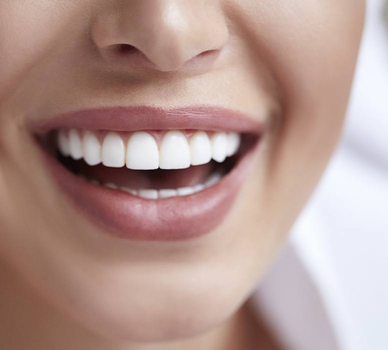 Closeup of smile after one visit dental restoration