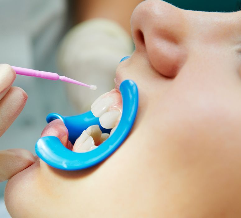 Patient receiving fluoride treatments