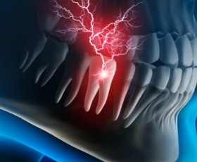 Animated tooth being struck by lightning signifying toothache