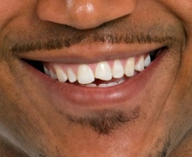 Closeup of smile with chipped front tooth