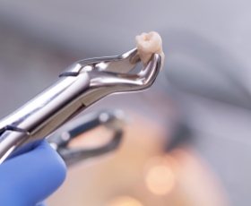 Metal clasp holding knocked out tooth
