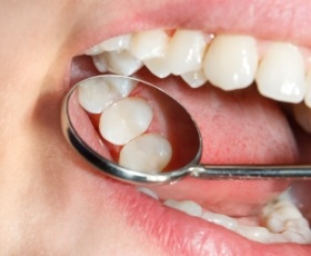 Closeup of smile after replacing lost dental crown