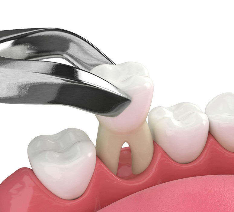 Illustration showing forceps pulling tooth from its socket
