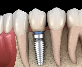 Animated dental implant supported dental crown