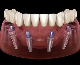 Animated dental implant supported denture