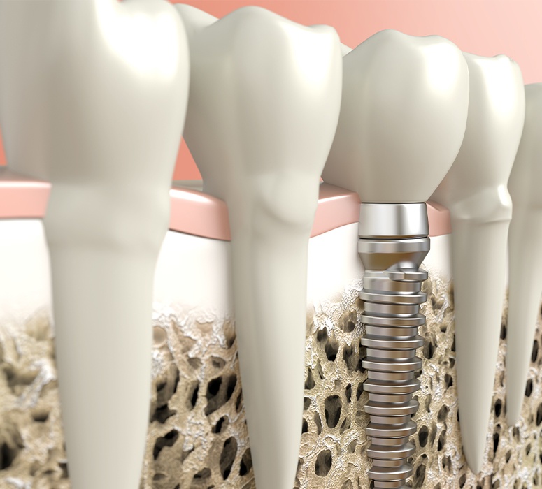 Animated smile with a new dental implant supported replacement tooth
