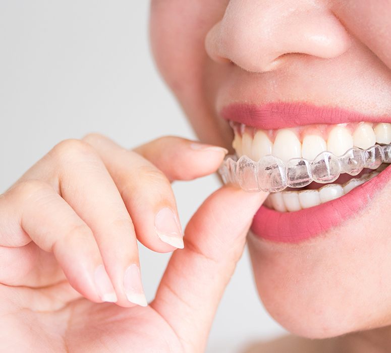 a patient inserting their Invisalign aligner