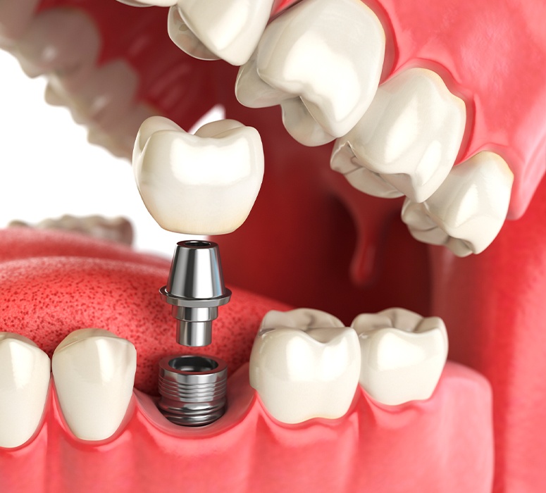 Animated dental implant placement