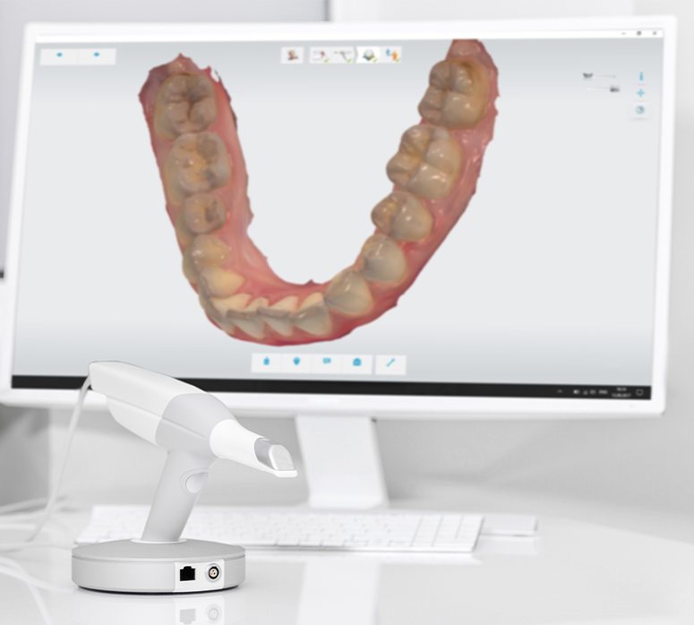 Digital bite impressions on chairside computer