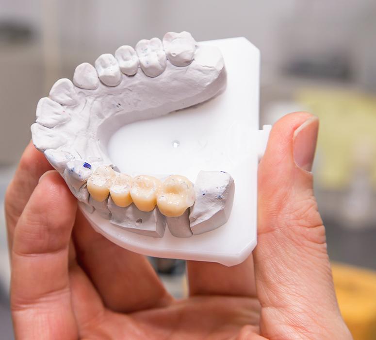 Model smile with dental bridge restoration