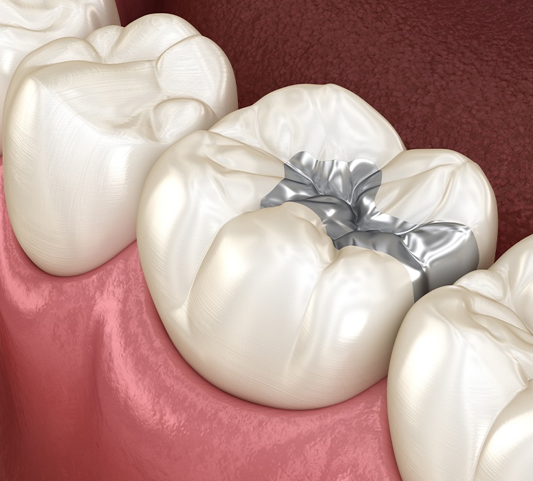 Animated smile with amalgam filling