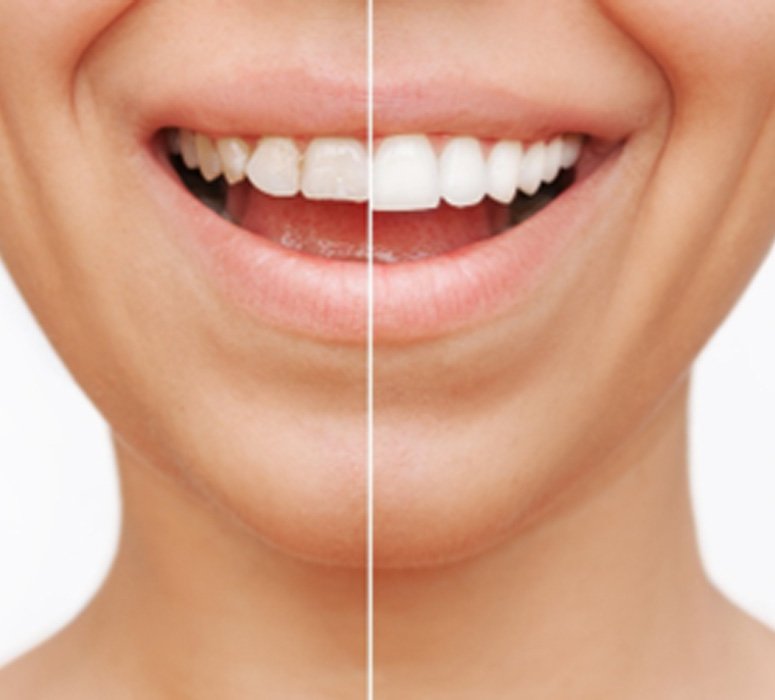 Closeup of patient's smile before and after veneers