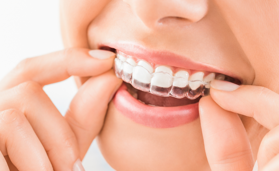 Woman with clear aligner