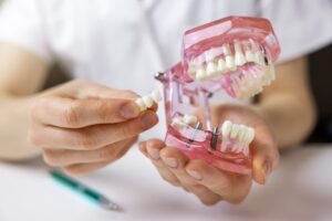 Dental bridge and mechanical model of mouth.